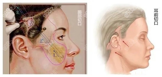 大眼睛整形做面部除皱的原理图