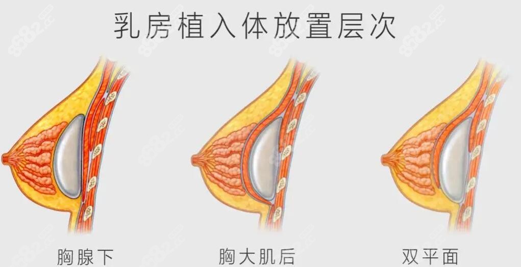 徐少骏隆胸好不好