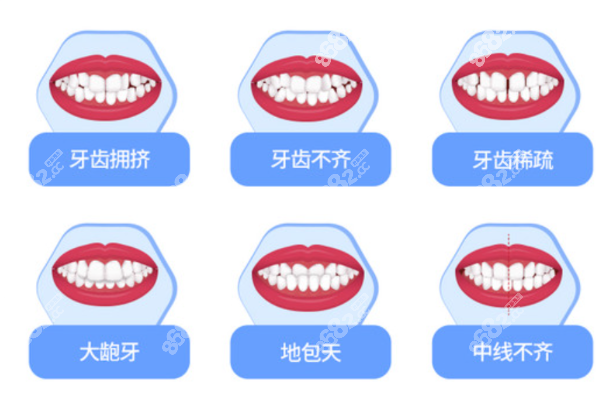 隐形透明牙套和金属钢丝牙套哪个好