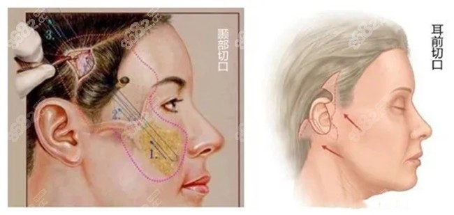 面部皮纹切口选择图图片