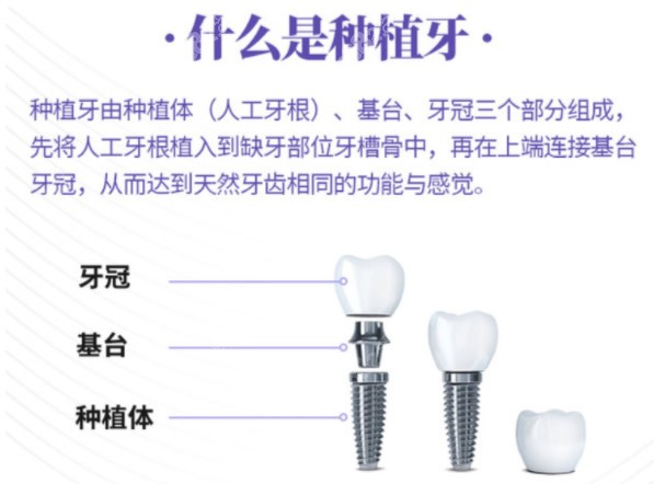 什么是种植牙