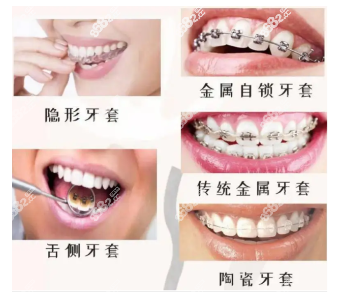 临安牙齿矫正价格表