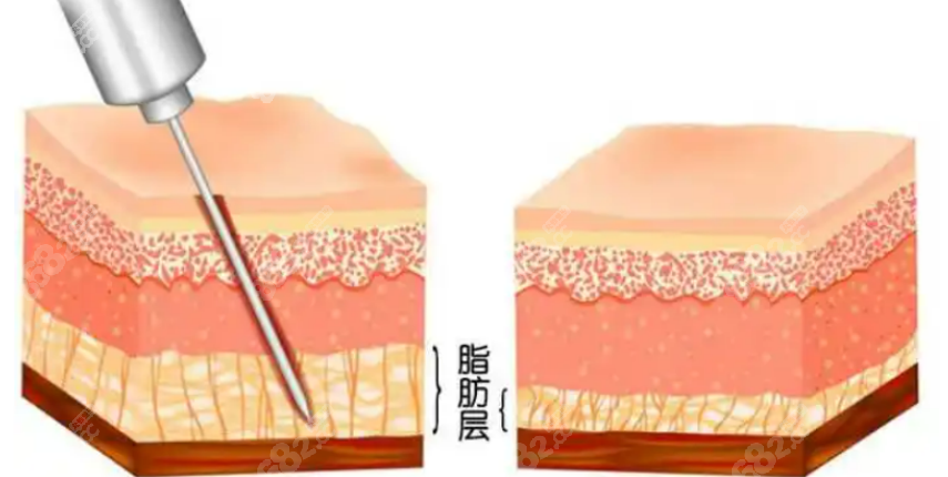 聚能振波吸脂和黄金微雕吸脂