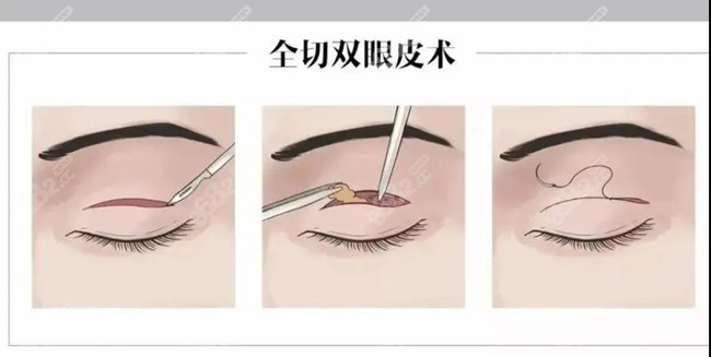 大眼睛整形做双眼皮的原理图