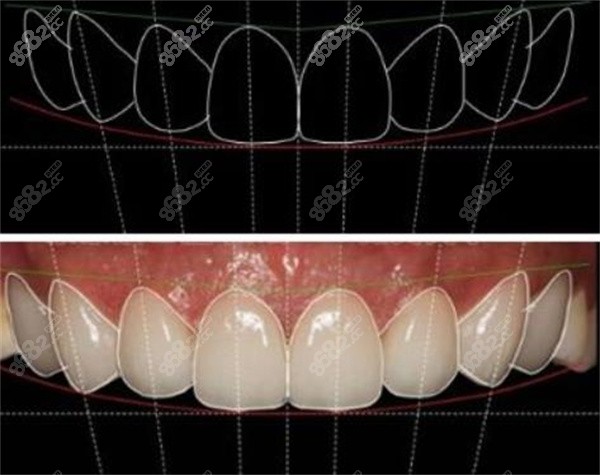 牙贴面3D数据