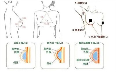 哈尔滨超龙整形孙湄杨假体隆胸优势2