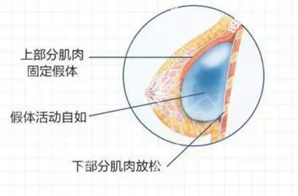 进口假体隆胸材料有哪些品牌8682.cc