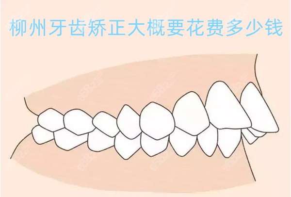 柳州牙齿矫正大概要花费多少钱