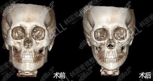 韓國愛我整形下頜骨整形前后對(duì)比