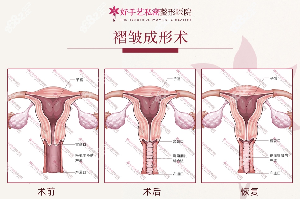 韩国好手艺缩阴手术价格400万韩币