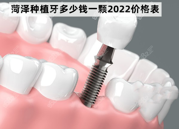 菏泽种植牙多少钱一颗2022价格表
