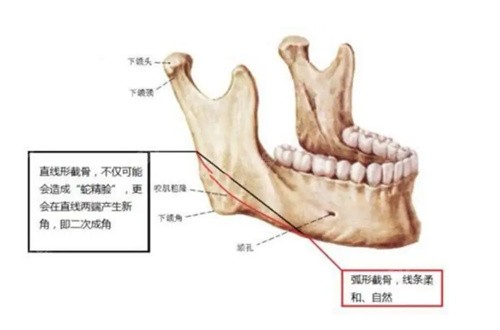 杭州高俊明做下颌角技术好