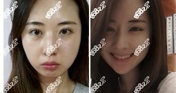 韩国必妩医院轮廓三件套手术前后对比图片