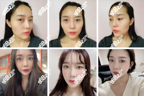 韓國愛我整形醫(yī)院下頜骨真實(shí)反饋