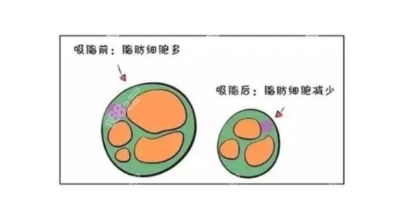 吸脂前后脂肪颗粒数量对比