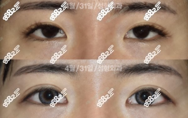 韩国431医院双眼皮窄改宽修复图片