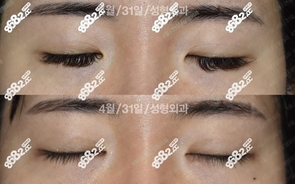 韩国4月31日医院眼睛修复图片