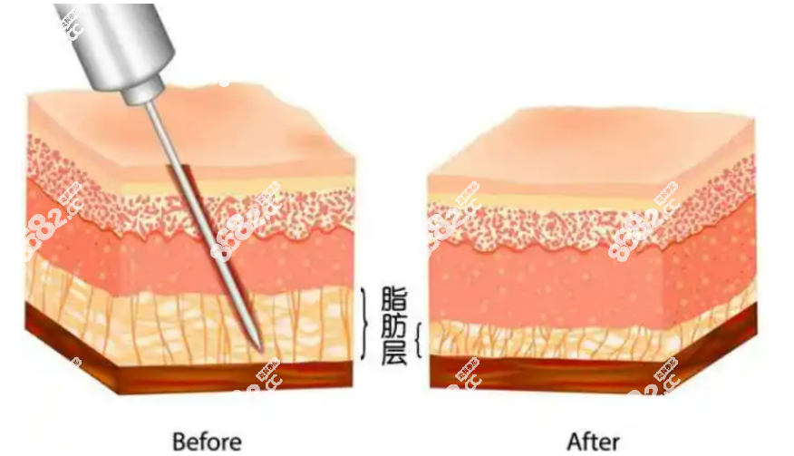 超脂塑吸脂