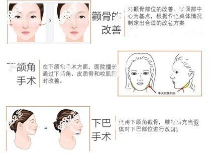 韩国轮廓三件套手术