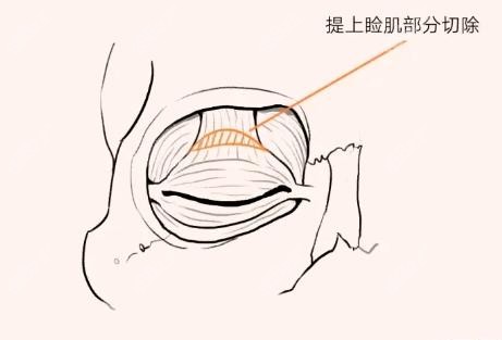 韩国双眼皮加提肌修复技术图