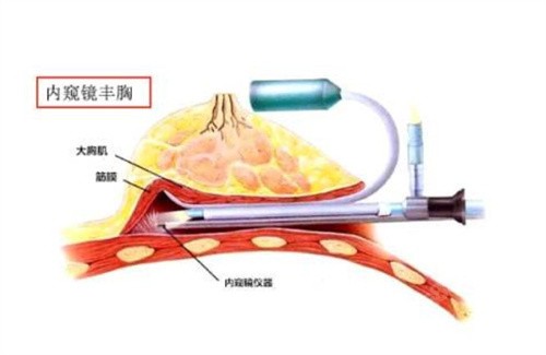 韩国必妩整形医院做轮廓和胸部整形技术好