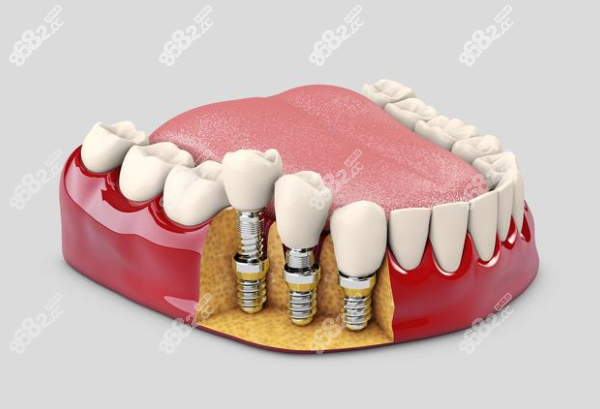 义乌世瑞口腔种植牙多少钱一颗