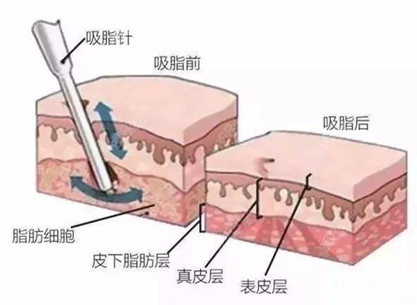 做全身吸脂术前术后的脂肪对比m.8682.cc