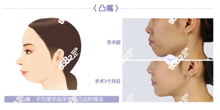 BK整形双鄂凸嘴手术对比图