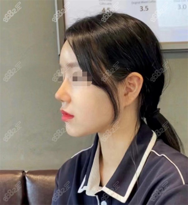 隆鼻术后