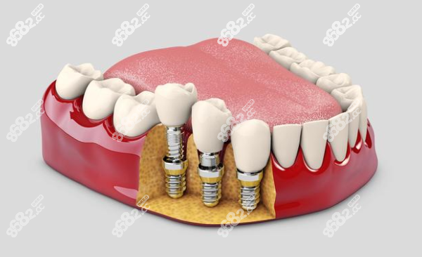 杭州<!--<i data=20240705-sp></i>-->口腔种植牙价格表