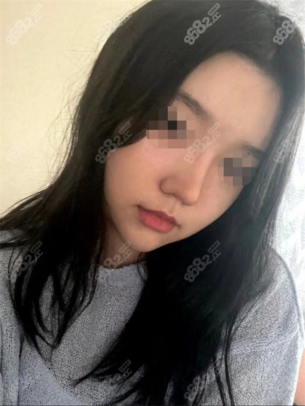 隆鼻术后