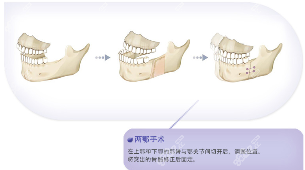 中国正颌手术和韩国正颌手术区别