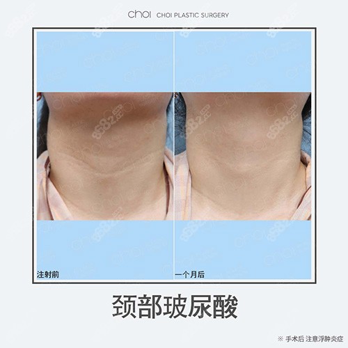 韩国CHOI整形医院去颈纹病例