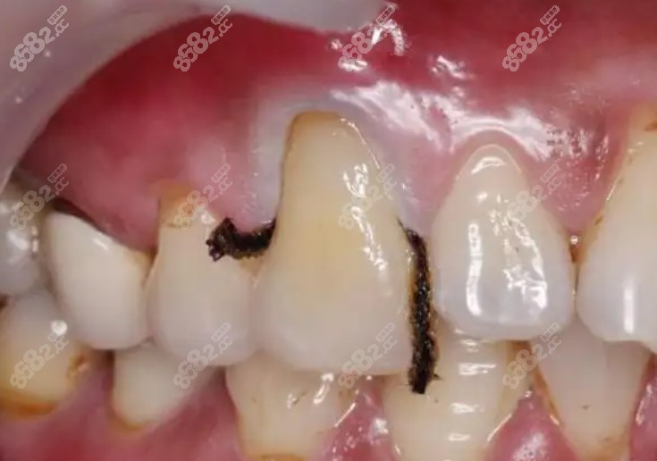 楔形缺损补牙的危害都在这,牙齿对比照片