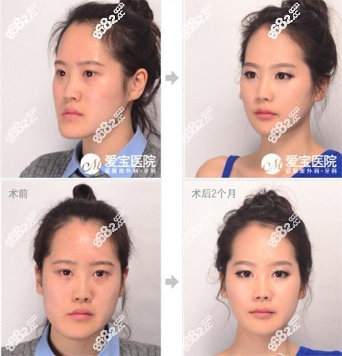 韓國愛寶整形醫(yī)院雙鄂對比圖