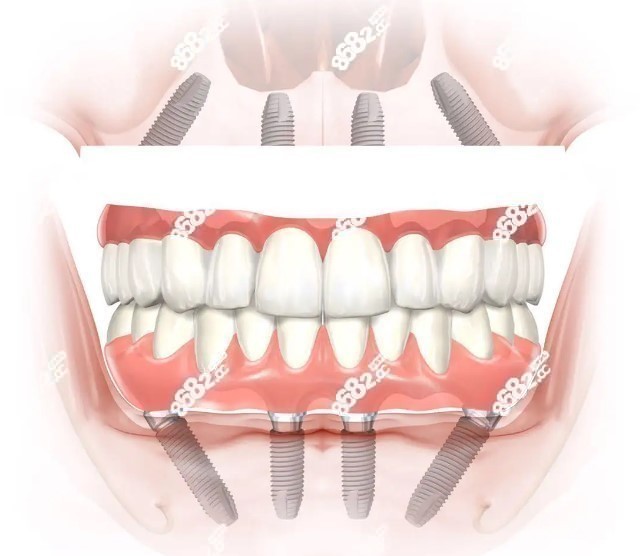 北京中诺口腔全口牙种植不贵