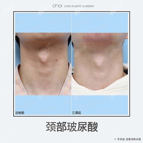 韩国CHOI整形医院去颈纹病例