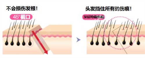 韩国ID整形额头缩小切口