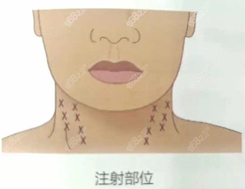 注射