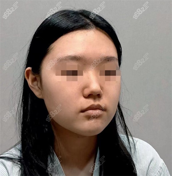 韩国优雅人术前
