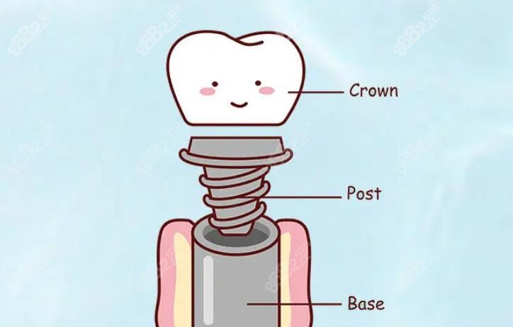 来这里做种植牙啊