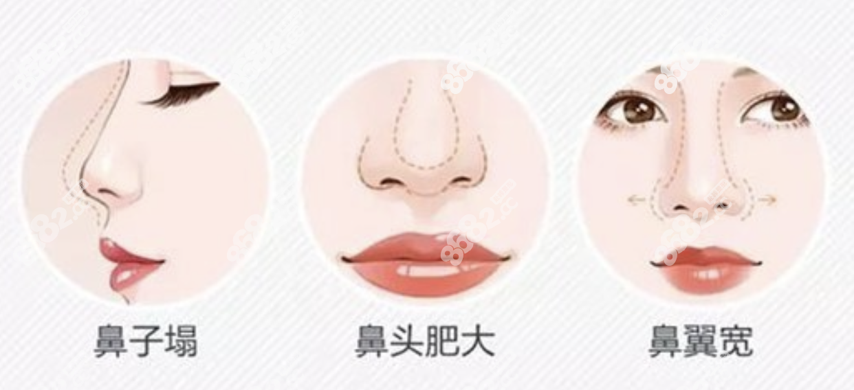 韩国鼻子修复手术价格在200-1000万韩币