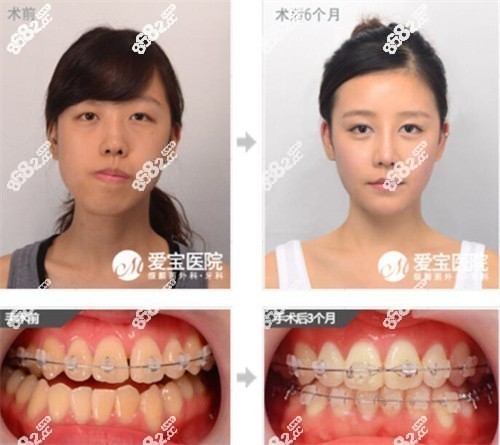 韓國愛寶整形醫(yī)院做雙鄂真實病例圖