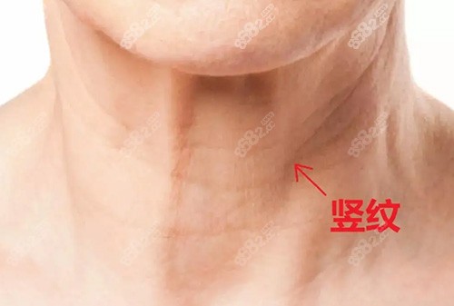 颈纹