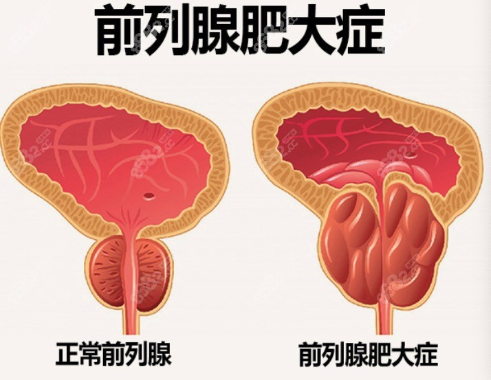 前列腺肥大