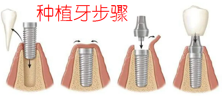 种植牙步骤~8682网
