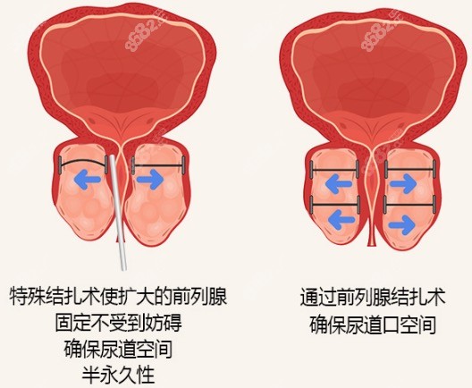 前列腺结扎术(UROLIFT)