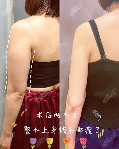 韩国宝士丽整形医院手臂吸脂术后恢复图