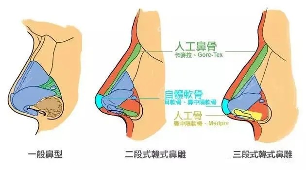 韩国欧佩拉整形做隆鼻手术的原理图