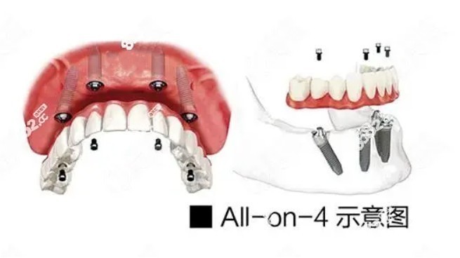 南京伯尼口腔半/全口种植牙价格